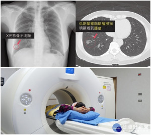 羅東博愛醫院推出肺癌篩檢推廣方案。（圖／羅東博愛醫院提供）。