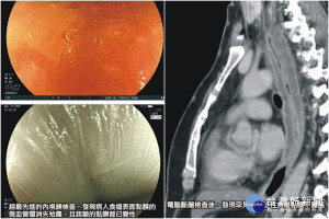 經醫生檢查發現病人罹患罕見的廣泛性食道黏膜腫脹及壞死。（圖∕羅東聖母醫院提供）