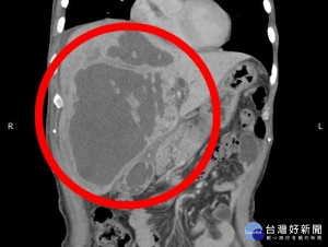 感染「阿米巴肝膿瘍」的原因都是飲食用水不乾淨，陳先生居住在山中時常生食，飲水也沒有特意煮沸，經檢查發現昏迷原因是肝臟有長達20公分的腫瘤