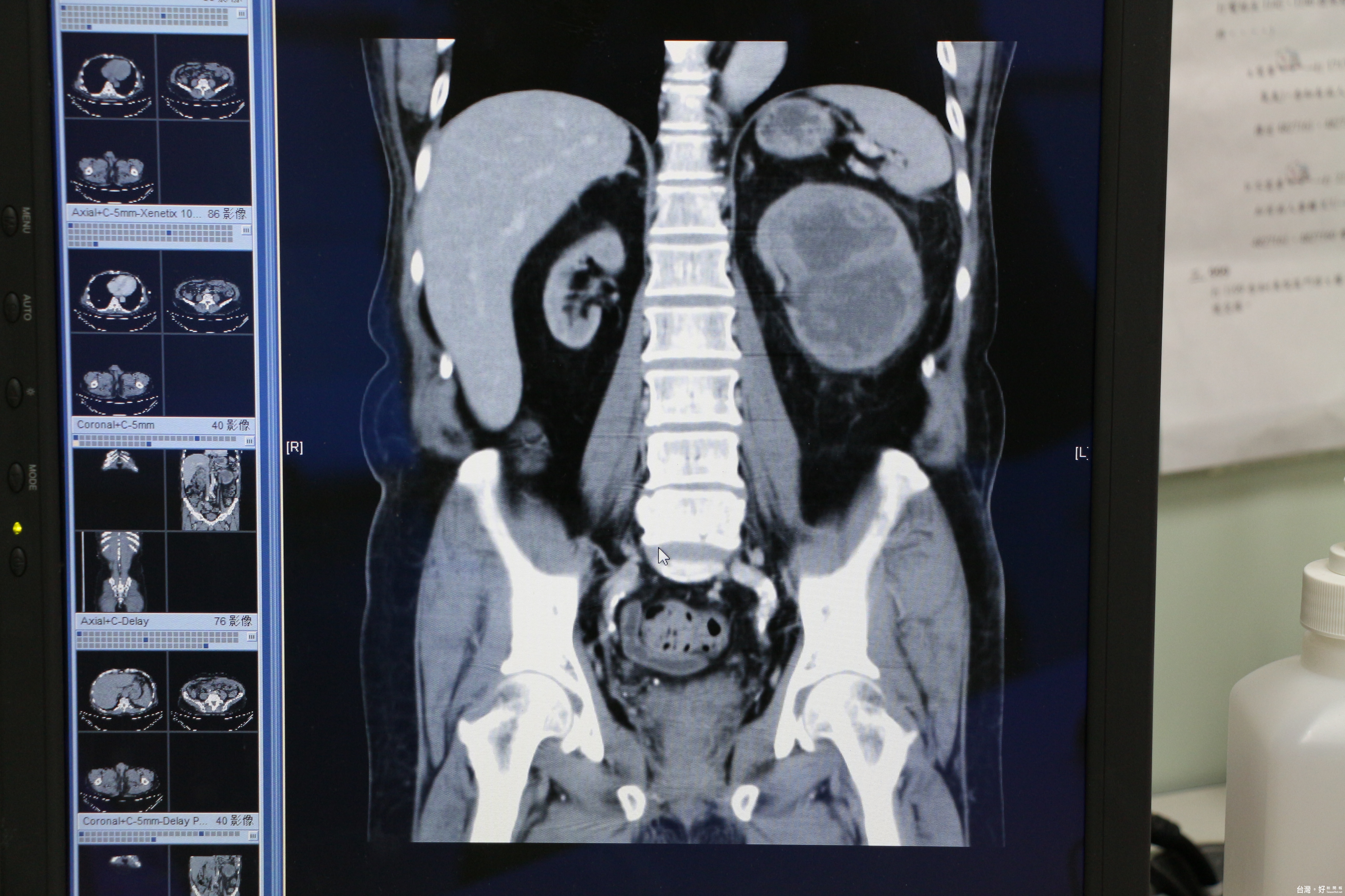 圖說2：因左側輸尿管上皮細胞癌引發左腎積水，明顯腫大。