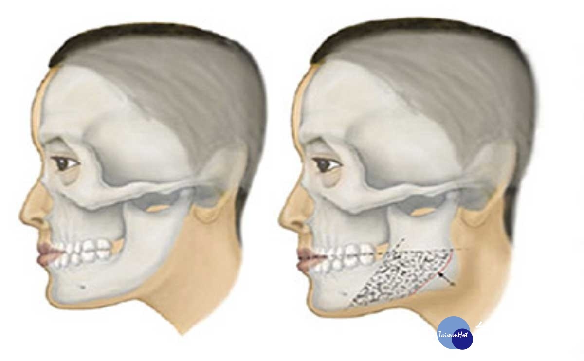 左圖是為傳統削骨，右圖為微創骨雕，前者只敲掉下頷角，後者同時磨除過寬過凸的皮質骨和切除下頷角。（圖／嘉仕美整形診所提供）