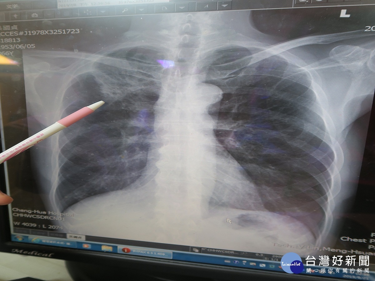 吞嚥不適以為喉嚨有問題　檢查竟是肺腺癌惹禍 台灣好新聞 第3張