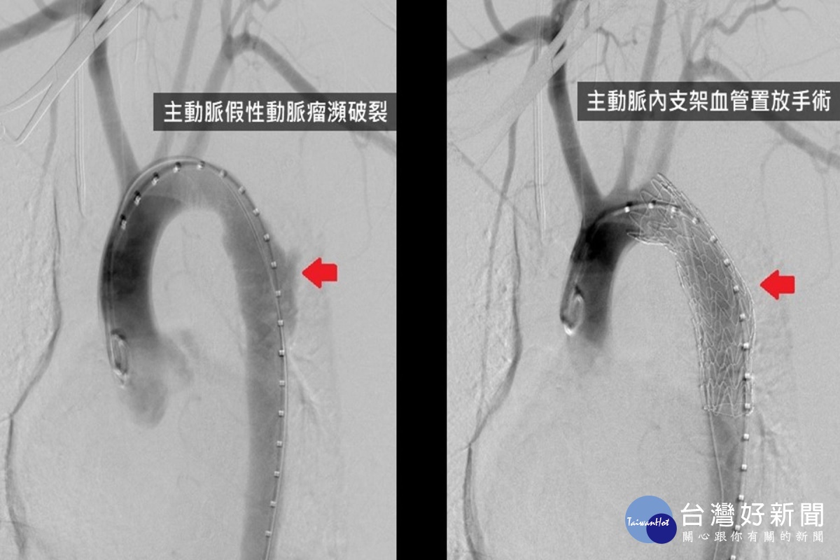 胸主動脈創傷致死率高　醫：主動脈支架血管置放手術是首選方法 台灣好新聞 第2張
